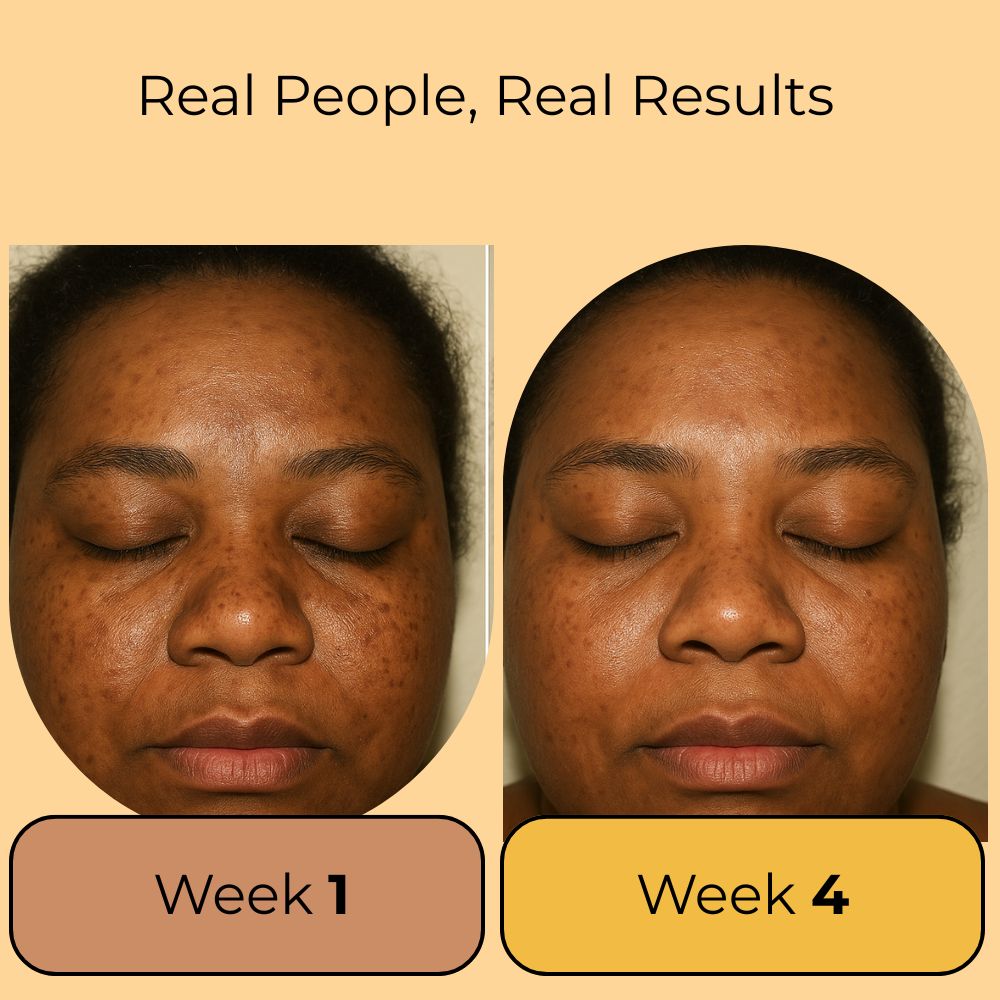 Turmeric Kojic Acid Soap Reduce Dark Spots Even Skin Tone